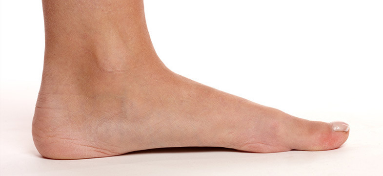 Conquer flat feet fumbles JustRunLah Conquer flat feet fumbles JustRunLah