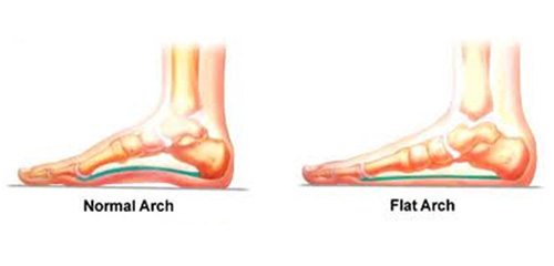 Conquer flat feet fumbles! | Just Run Lah!